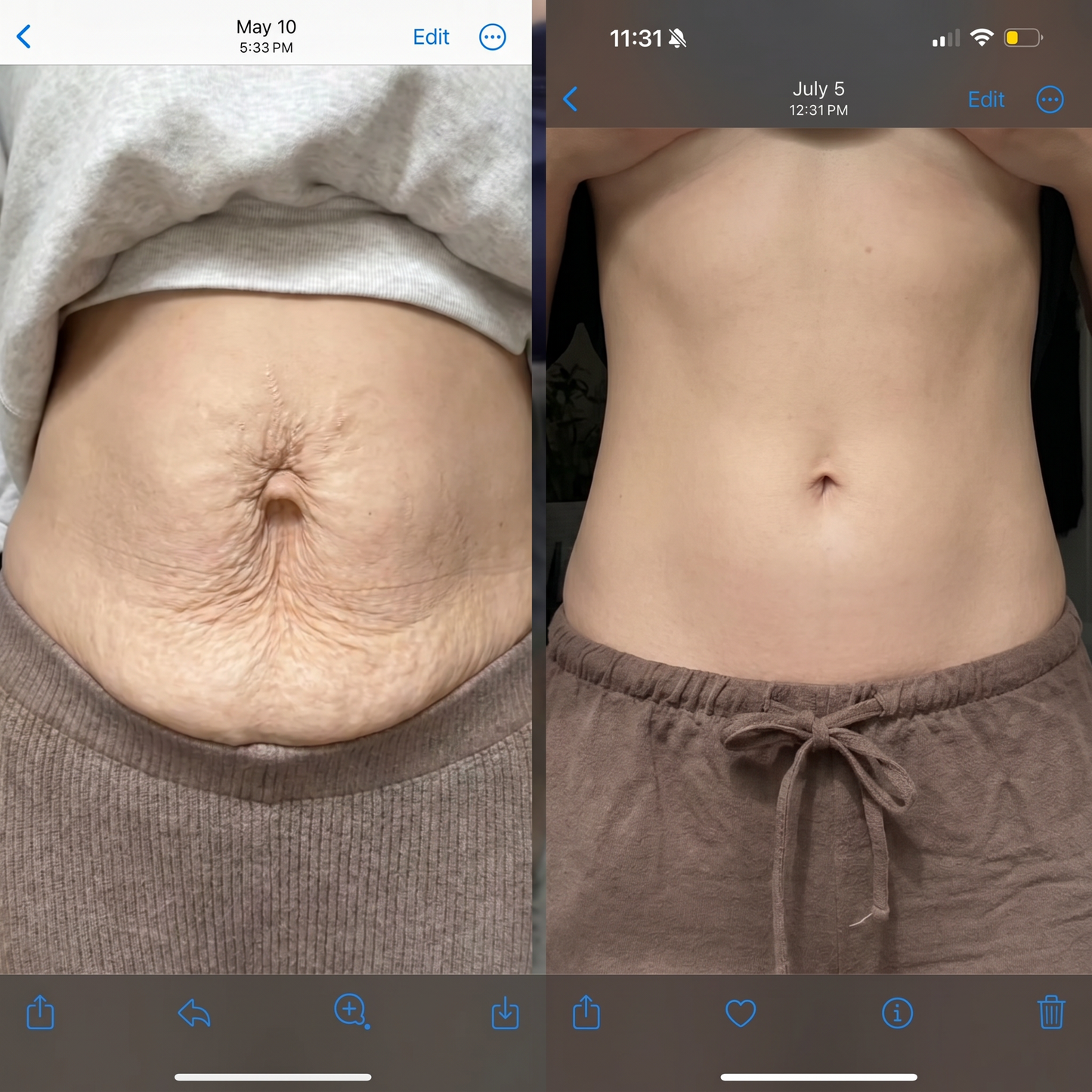 Red light belt - Stretch marks visibly reduced in 9 weeks