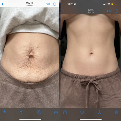 Red light belt - Stretch marks visibly reduced in 9 weeks